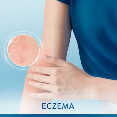 Eczema Products
