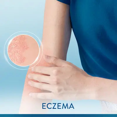 Eczema Products