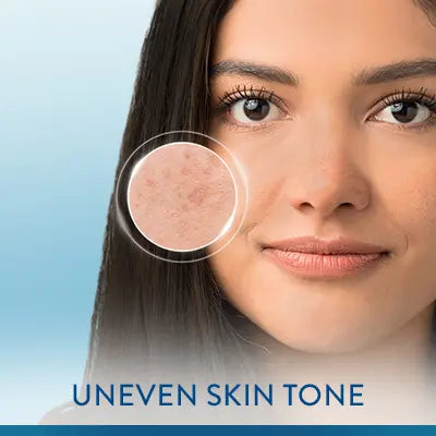 Uneven Skin tone